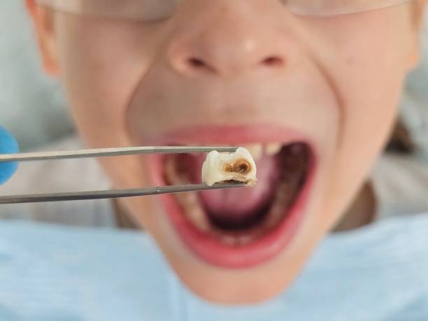 Best Tooth Infection Emergency Dentist  in Rossvle, IL